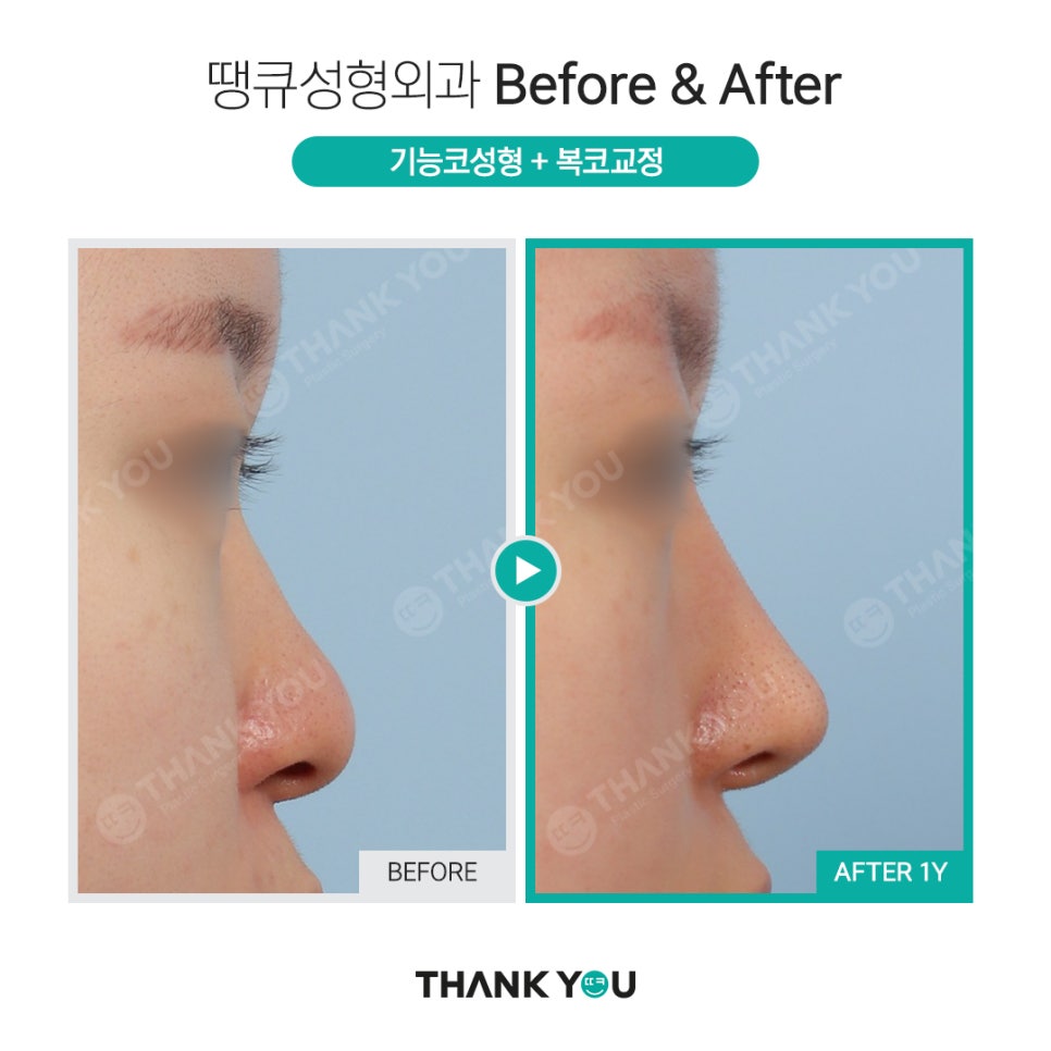 강남 코성형 전후, 코수술 잘하는 곳? 관련 이미지 5