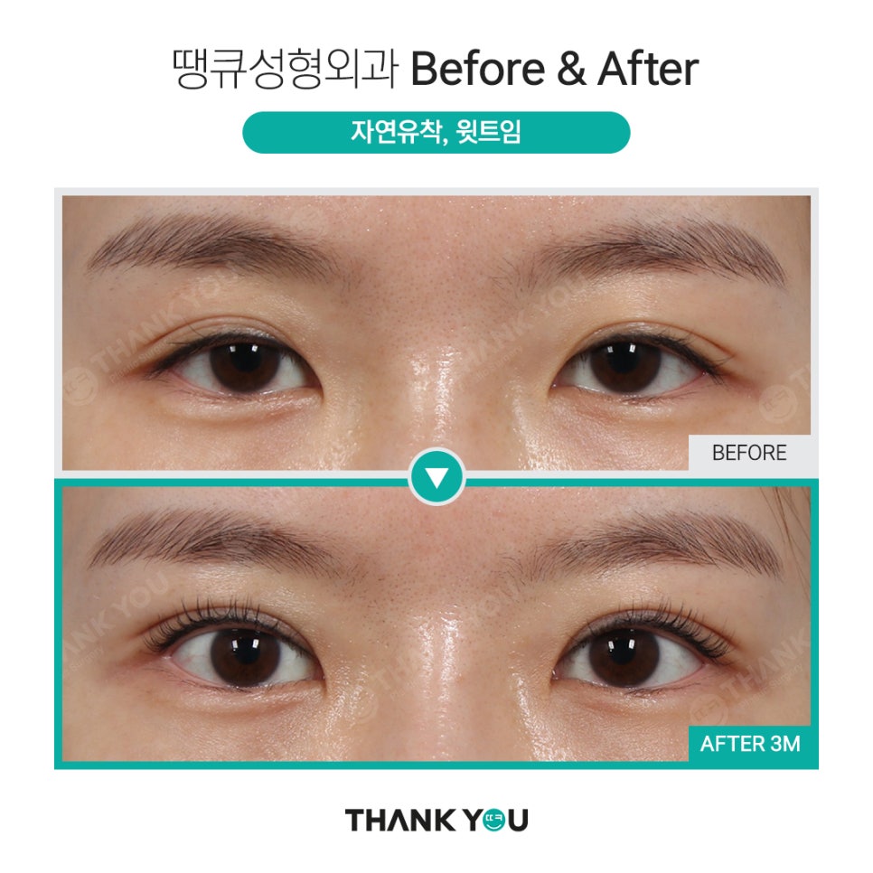 쌍수 뒷트임 (앞트임,밑트임, 듀얼트임 종류) 전후사진 관련 이미지 12