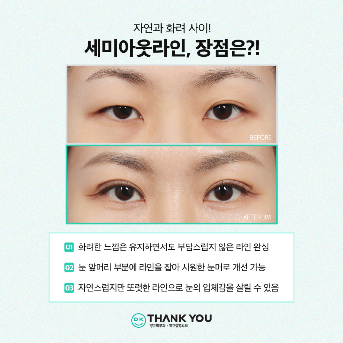 쌍수잘하는곳에서 세미아웃라인쌍꺼풀로 예쁜 눈 변신! 관련 이미지 3