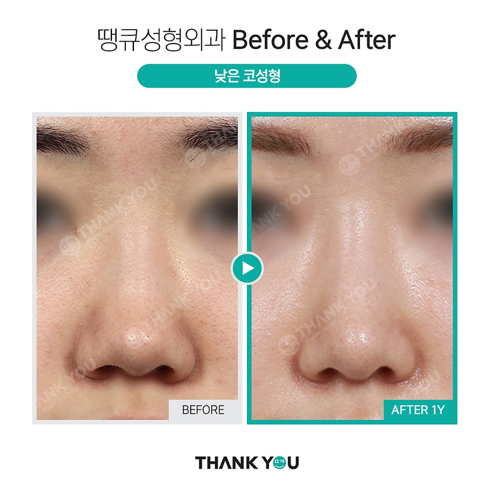 짧은코 교정의 역발상, 짧은코 성형 전후 관련 이미지 8
