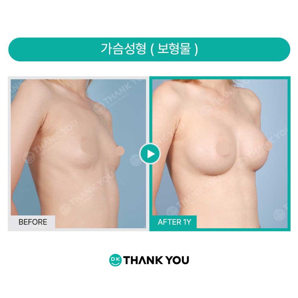 가슴수술주의사항 관련 이미지 8