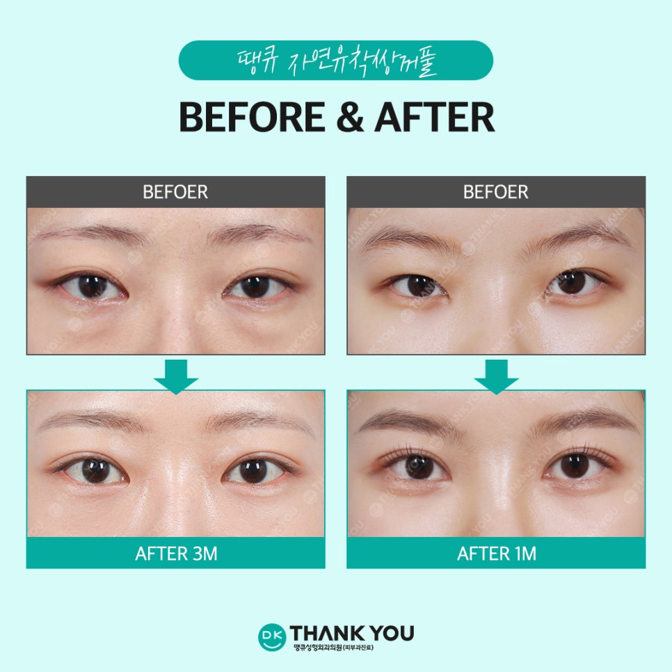 Natural adhesion double eyelid review: Beautiful, naturally-looking lines completed at Thank You! image 6