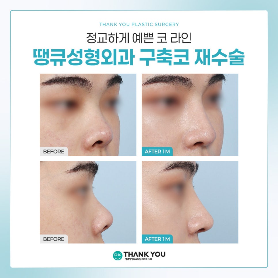 What Does a Contracted Nose Mean, and How Is Revision Surgery Performed? ❓Why Stem Cell Treatment Is Gaining Attention image 4