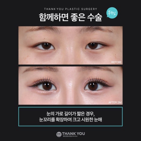 눈매교정잘하는곳 땡큐에서 더 또렷하게, 더 자연스럽게! 관련 이미지 8