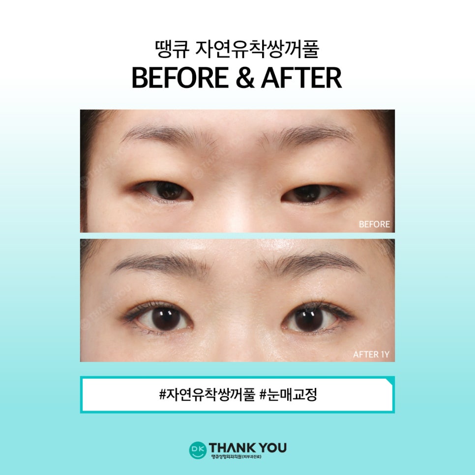 Natural Adhesion Double Eyelids: If You Want Naturalness That Lasts Longer image 7
