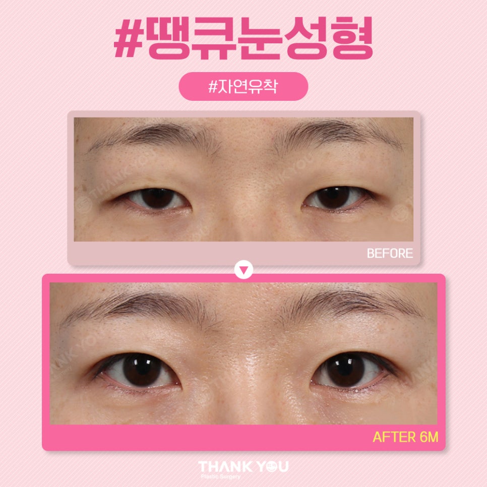 땡큐 쌍꺼풀 전후사진 비교 Before & After 관련 이미지 7