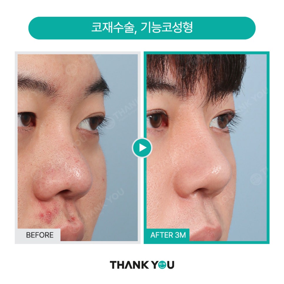 땡큐 맥미남, 뮤지컬배우 남자 복부지방흡입 전후 Check 관련 이미지 10