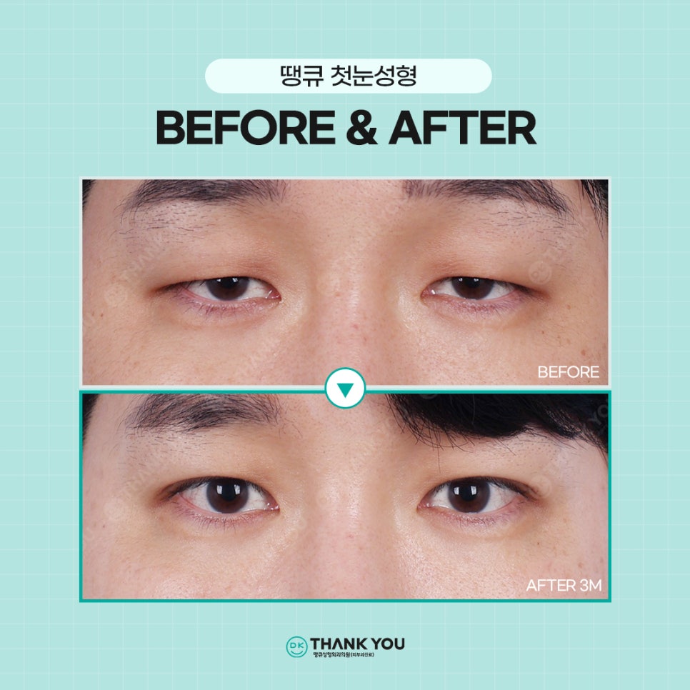 첫눈성형, 자연스럽고 조화로운 결과를 위해서는?! 관련 이미지 10
