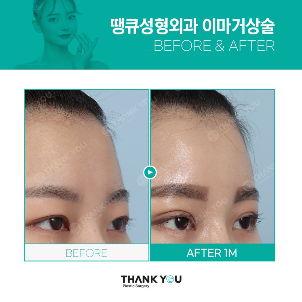 20대 30대를 위한 엔도타인 눈썹올림술(이마거상) 이란? 관련 이미지 9