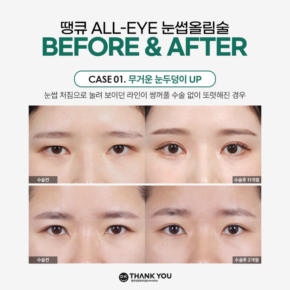 Improving Drooping, Tired-Looking Eyes in One Go with Forehead Lift Surgery! image 4
