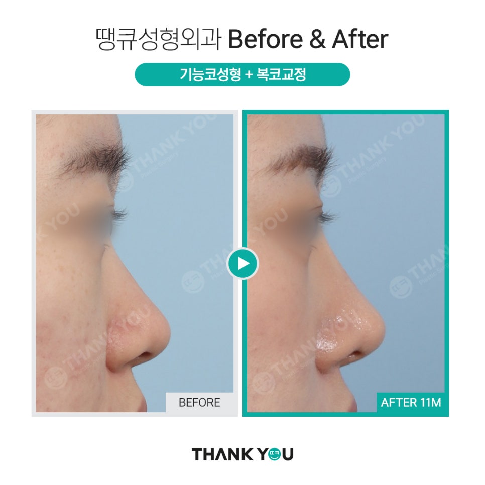 강남 코성형 전후, 코수술 잘하는 곳? 관련 이미지 9