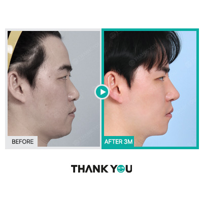 MAKE미남(맥미남) 오덕차장님의 노안 개선&남자 비염코성형 전후 관련 이미지 7