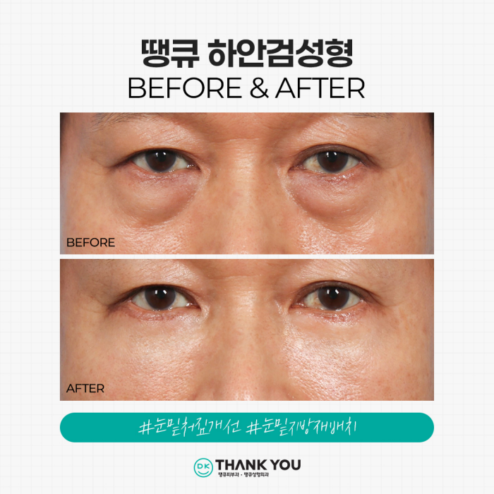 Solving Under-Eye Aging with Lower Blepharoplasty! image 5