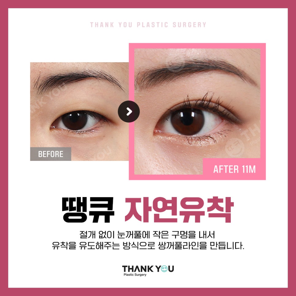 신논현역 성형외과에서 쌍수 전후 Check✨ 관련 이미지 8