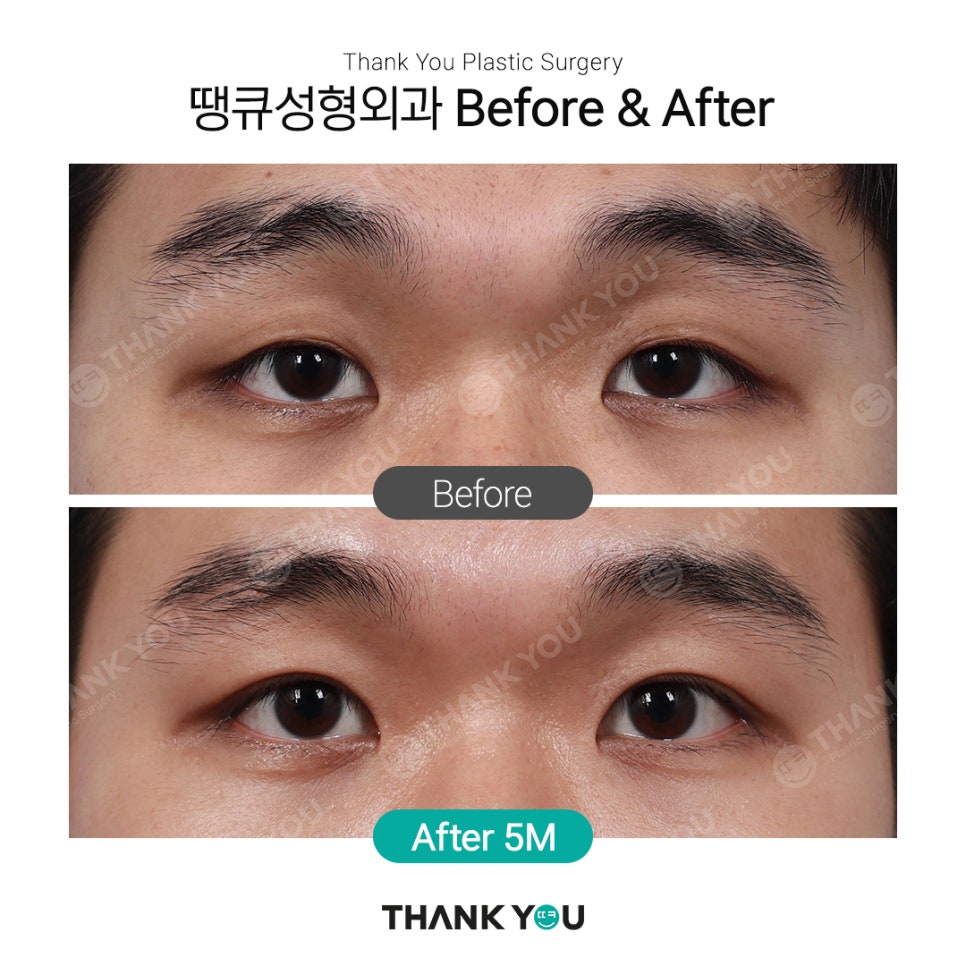 쌍꺼풀 라인 종류, 인아웃+세미아웃라인 Before After 관련 이미지 1