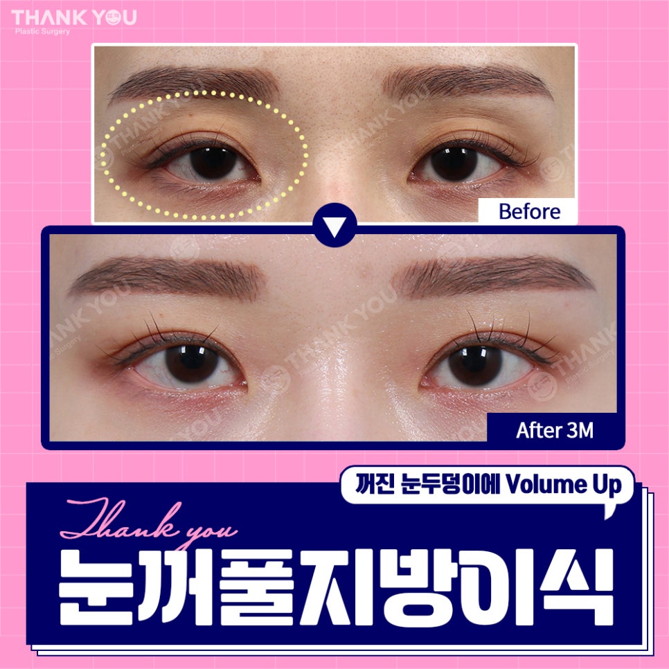 눈꺼짐? Thank You눈꺼풀 지방이식으로 볼륨UP 관련 이미지 6