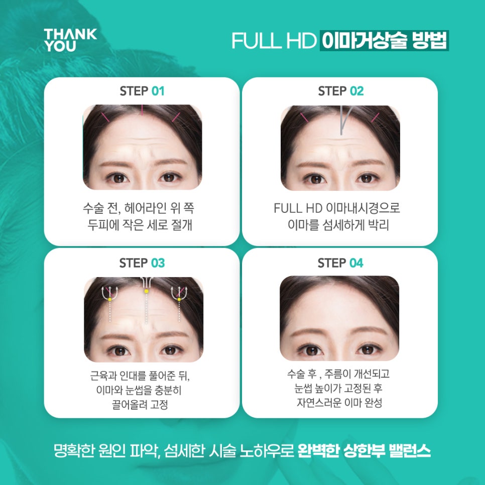 20대 30대를 위한 엔도타인 눈썹올림술(이마거상) 이란? 관련 이미지 4
