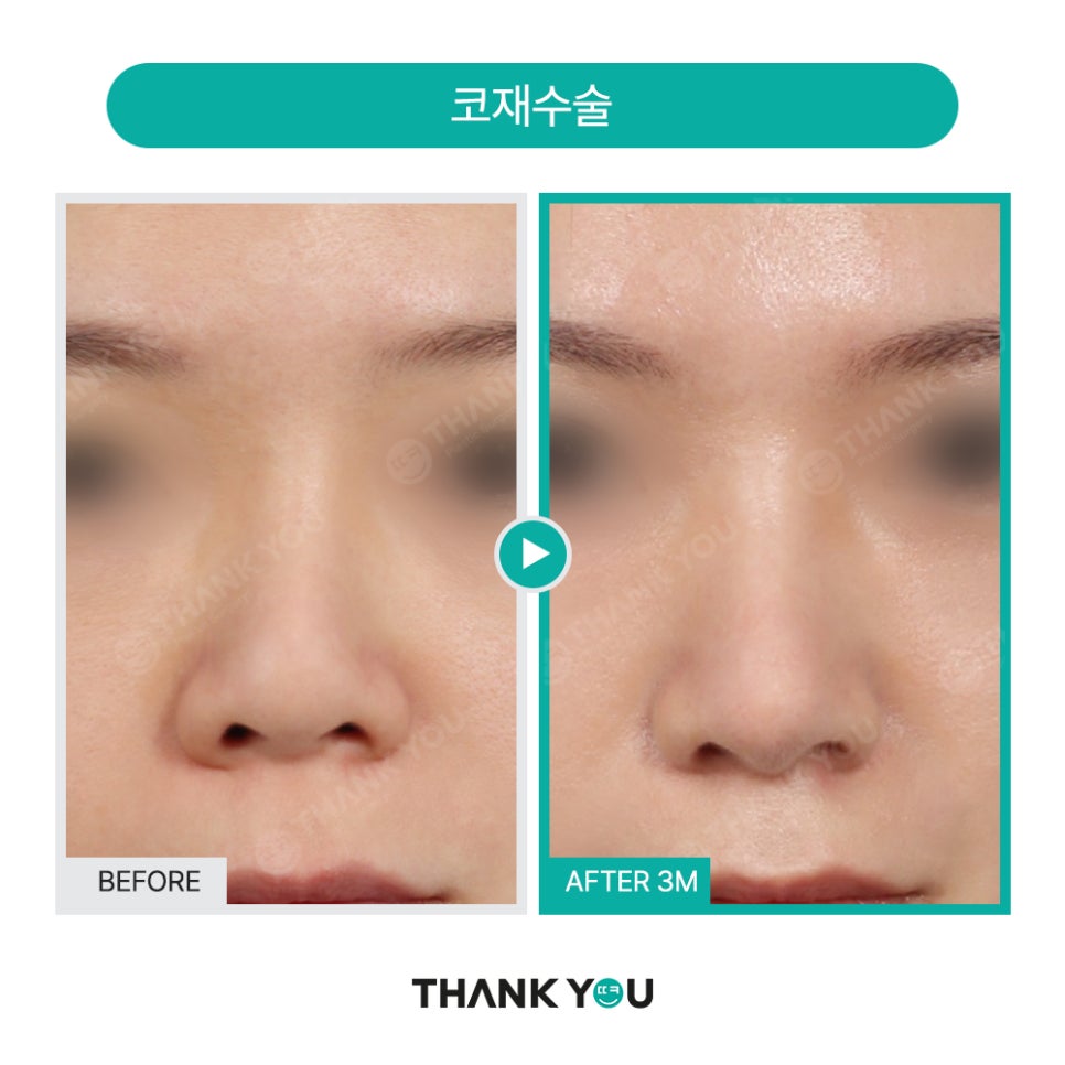 코성형 실리콘 비침, 코낮추기 재수술로 매끈하게 관련 이미지 18
