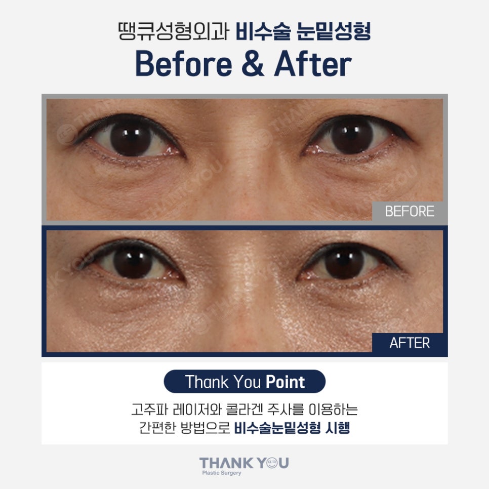 비수술 눈밑성형, 레이저 눈밑지방재배치란? 관련 이미지 8