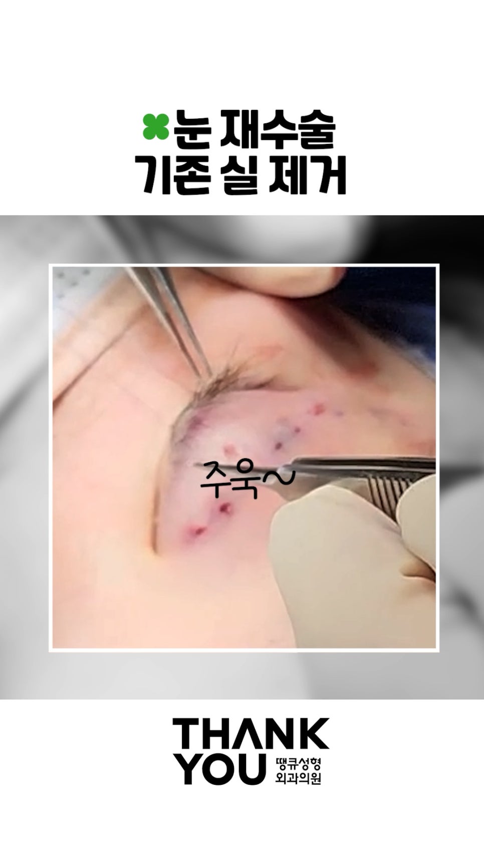 매몰 풀기, 매몰 실 제거 (15년 묵은 실)재수술 쌍꺼풀 관련 이미지 4