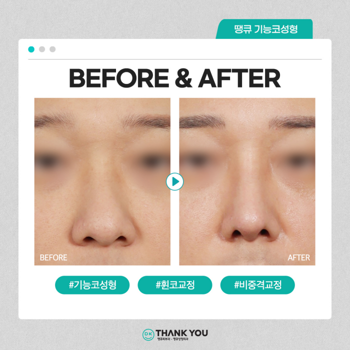 기능코수술병원에서 콧 속 불편함, 외적 스트레스 동시 해소! 관련 이미지 12
