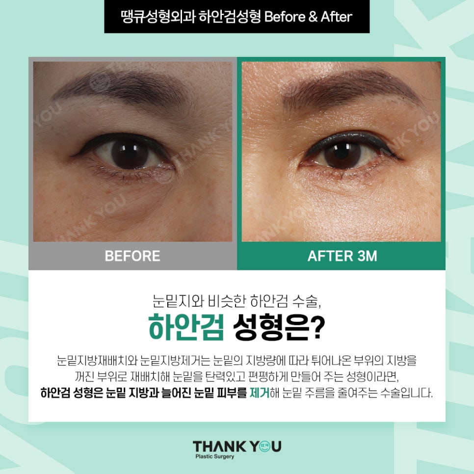 눈밑지 눈밑지방제거, 하안검 차이점은? (눈밑 비포&애프터) 관련 이미지 6