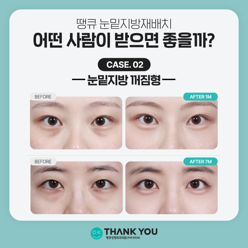 Under-Eye Fat Repositioning Event! Special Benefits for Exam Takers Prepared by Thank You 💫 image 5