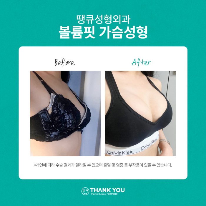 땡큐성형외과 가슴성형 이벤트✨ 관련 이미지 2