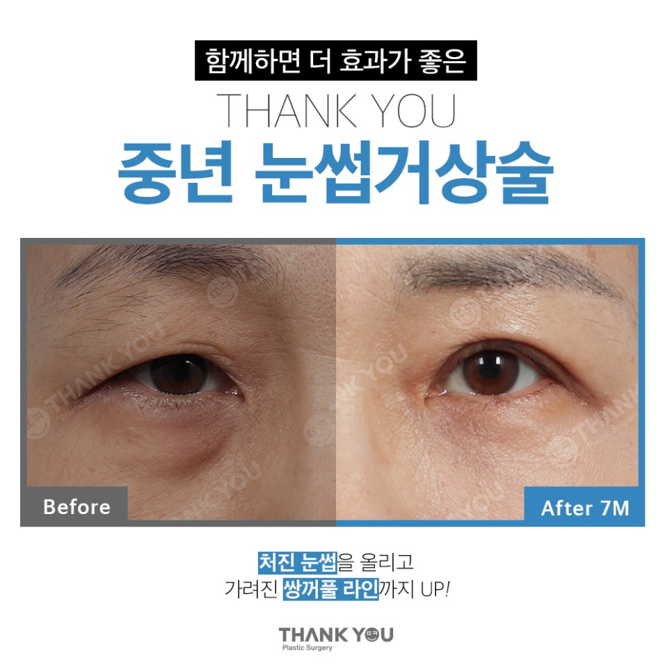 중년눈수술, 50대 60대 눈처짐과 눈꺼풀짓무름 해결법 관련 이미지 13