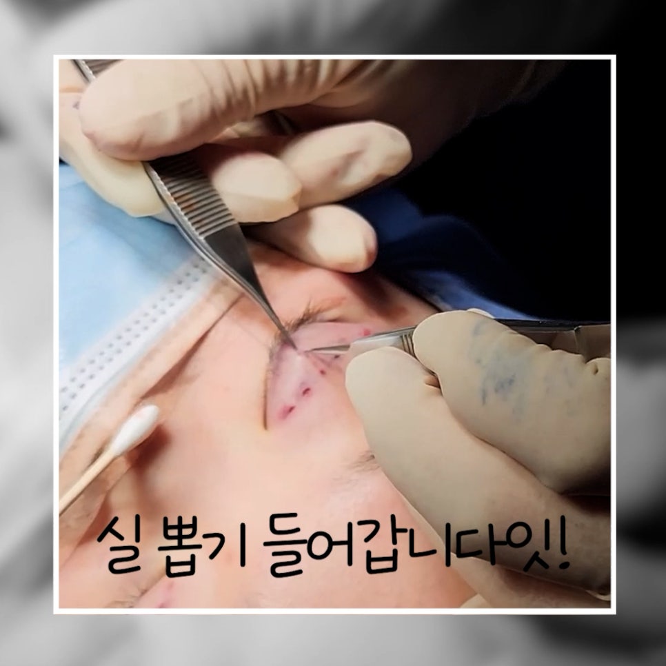 매몰 풀기, 매몰 실 제거 (15년 묵은 실)재수술 쌍꺼풀 관련 이미지 1