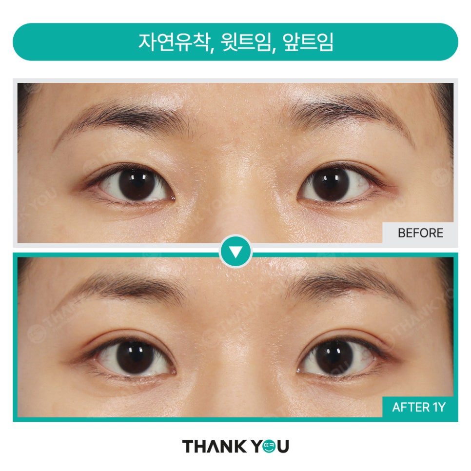 [비절개눈매교정+앞윗트임+눈밑지] 자고 일어났을 뿐인데 제니가?! 관련 이미지 23