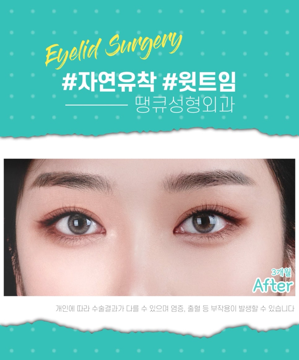 쌍수 윗트임 전후, 내게 맞춘 쌍트 수술로 화려하게 관련 이미지 2