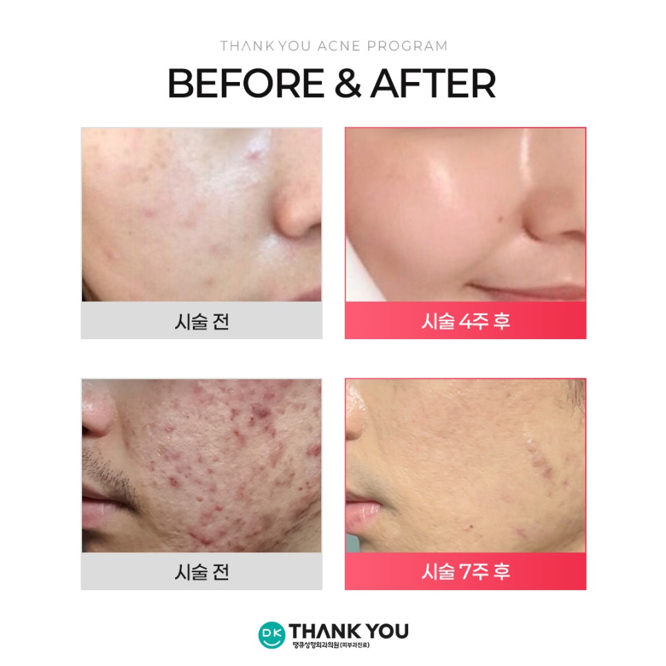 Curious About the Effects of Acne Scaling? Find Out at Thank You! image 6