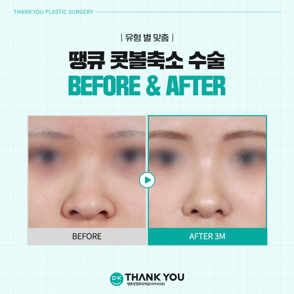 Rhinoplasty Before and After? See the Stylish Nose Created at Thank You Here! image 10