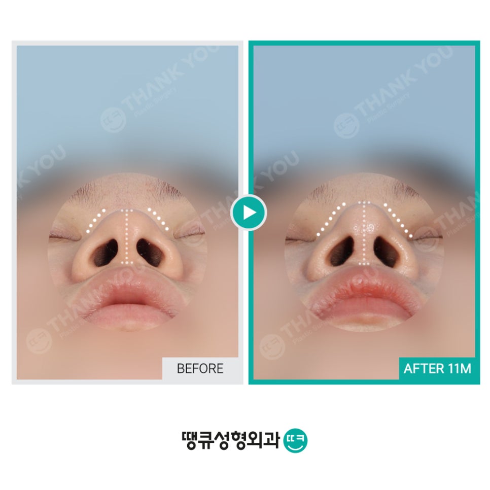 숨이 잘 안쉬어져요 실비코성형 비염도 기능코로 라인 커버! 관련 이미지 3