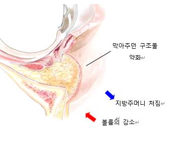 눈밑지방재배치 수술해도 재발할까요? 관련 이미지 3