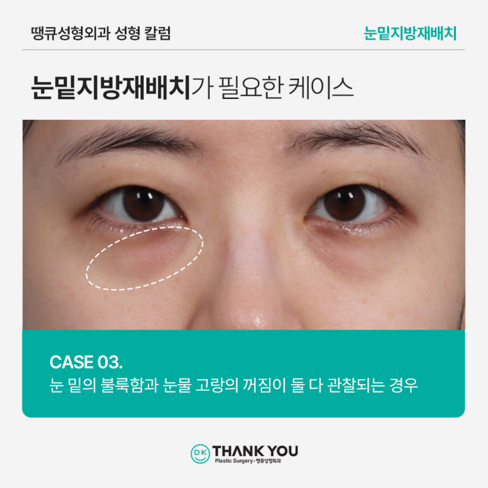 눈밑지방재배치병원에서 알려주는 수술이 필요한 케이스 관련 이미지 6