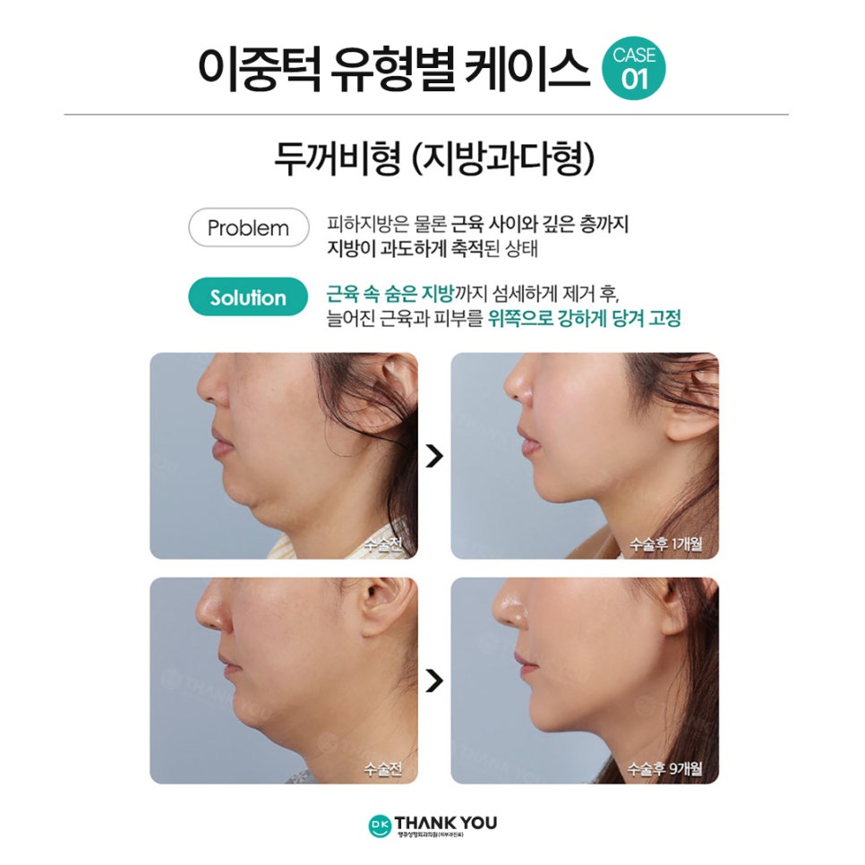 Not Enough Improvement from Chin Liposuction Alone? How About Thank You Double Chin Removal Surgery?! image 6
