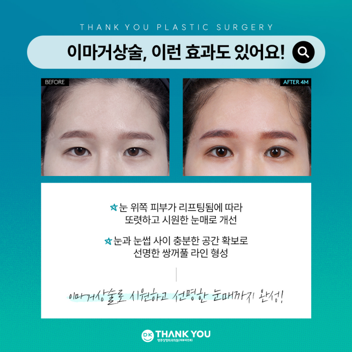 What Are the Effects of a Forehead Lift?[Column by Director Kim Gyu-beom] image 5