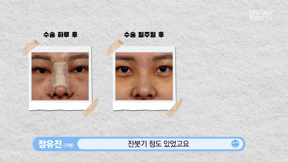 뚱뚱한 코 탈출! 실리콘 코성형👃(직원 코성형 브이로그2탄) 관련 이미지 13