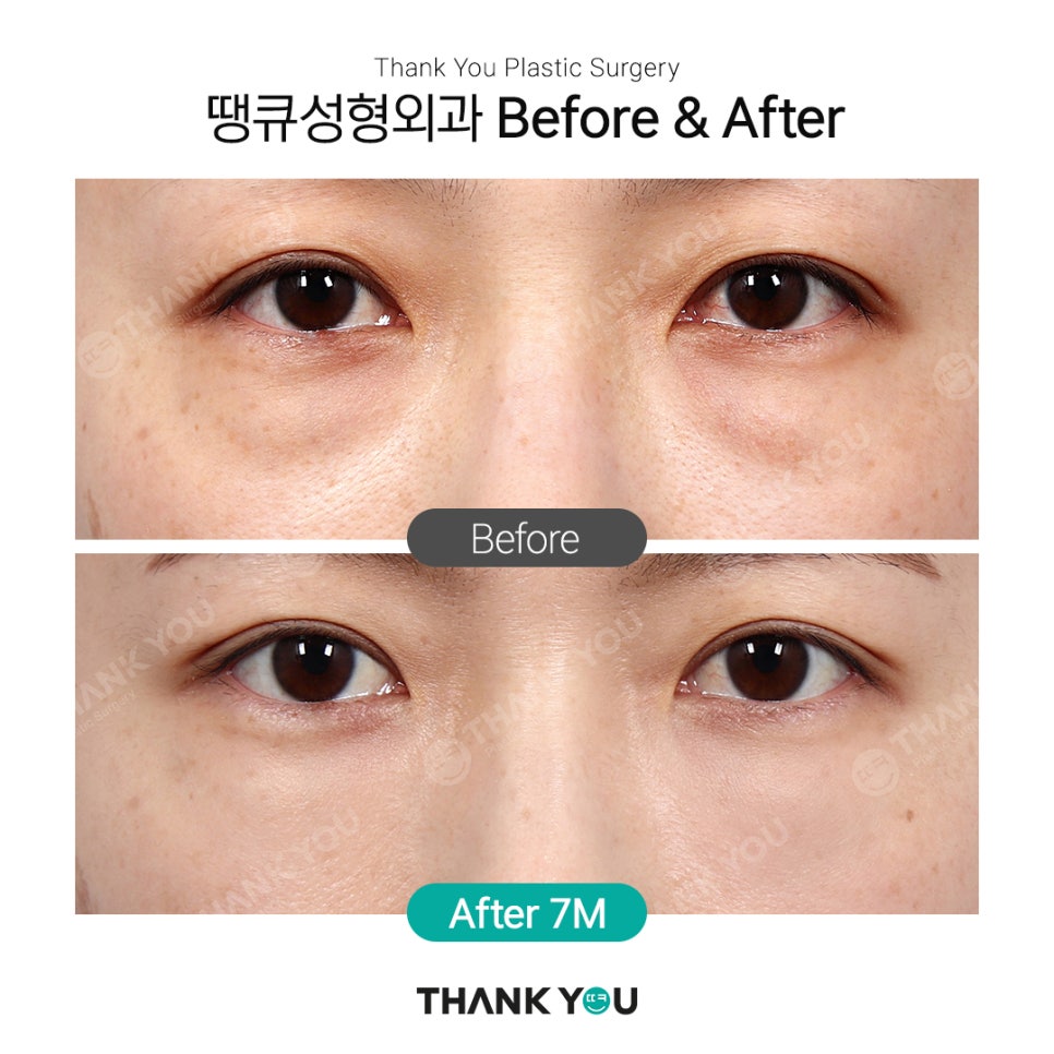 강남 눈밑지방재배치(전후 체크) THANY YOU이벤트 관련 이미지 2