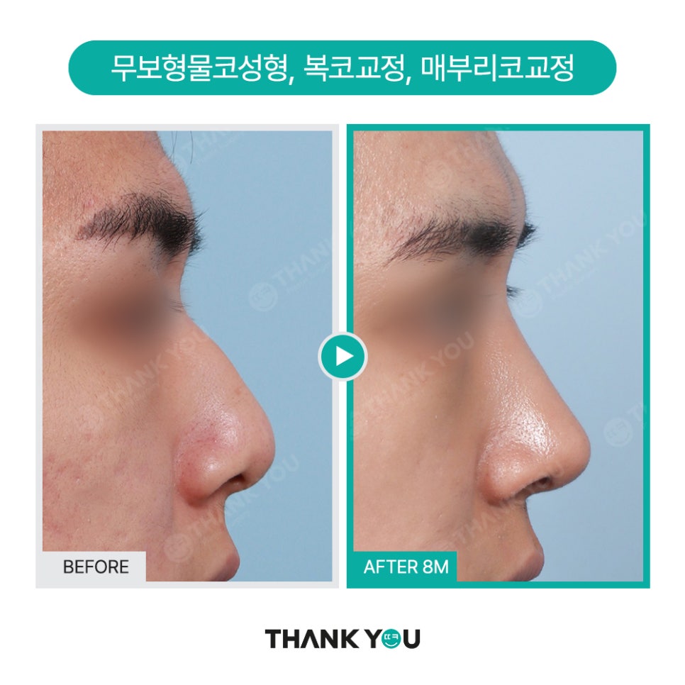 남자코성형 (휜코, 매부리코 등) 기능코성형 필요! [ft.코수술전후] 관련 이미지 18