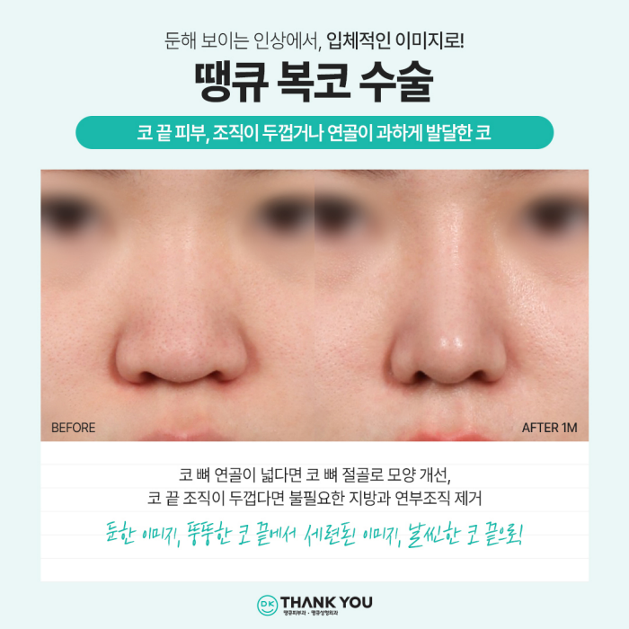 강남코성형 성공 방법은?! 코성형잘하는병원과 함께! 관련 이미지 4