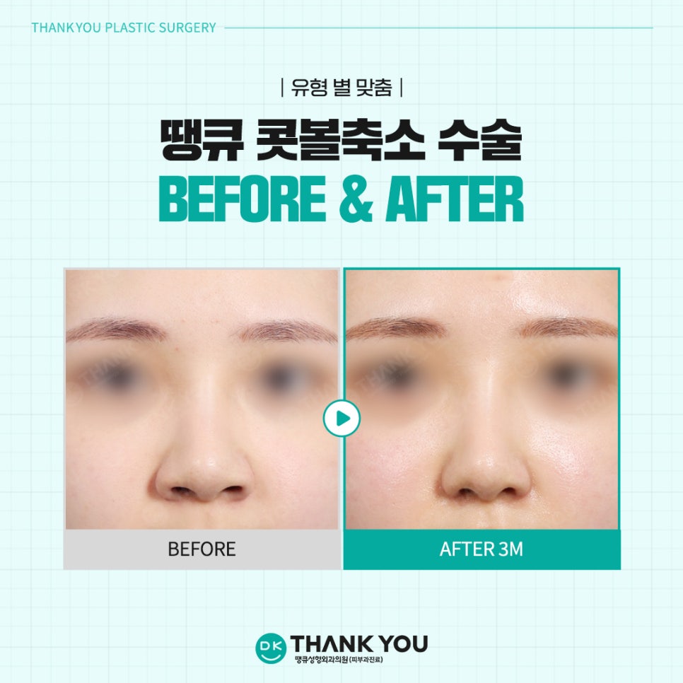 Rhinoplasty Before and After? See the Stylish Nose Created at Thank You Here! image 12