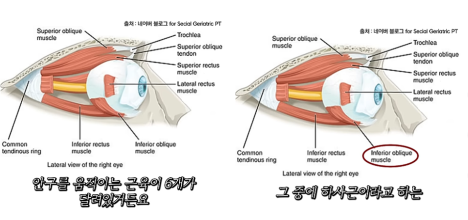 눈밑지방재배치 사시 부작용 궁금증 해소해 드립니다! 관련 이미지 3
