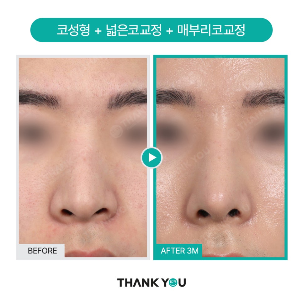 넓은코, 큰코성형 매부리코교정 찾는다면? 관련 이미지 6