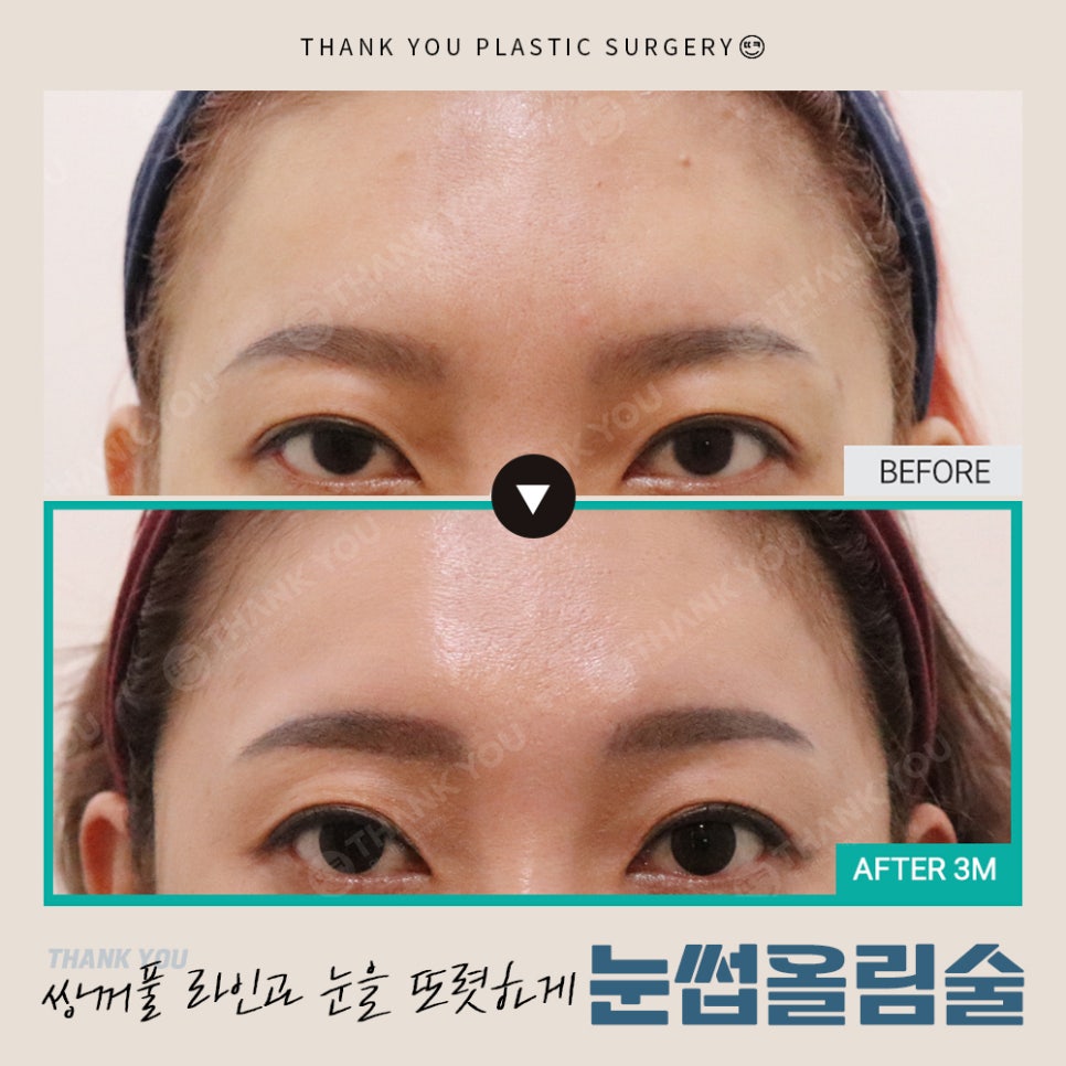 쌍수에 눈썹올림술을 추천하는 이유?! 관련 이미지 18