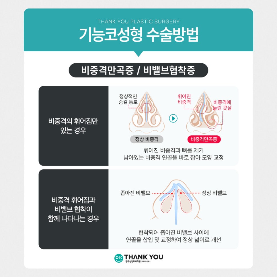 기능코성형, 비염수술코성형 유형별 수술법 알아보기 관련 이미지 8