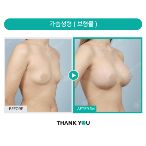 가슴지방이식수술 경험이 있어도, 보형물 수술이 가능한가요? 관련 이미지 5