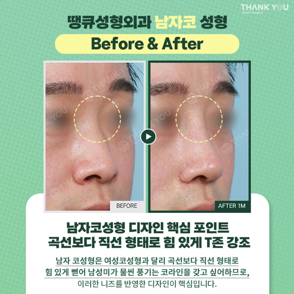 남자코성형 전후 비포애프터&T존 뚜렷한 직선 디자인으로 관련 이미지 3